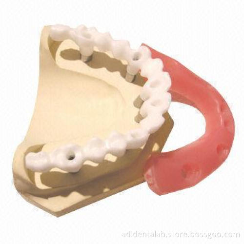 Zirconia Bridge Implant, Porcelain Directly Fired onto Abutment